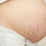 Why Stretch Marks Appear & How AreoVeda Helps Reduce Their Appearance