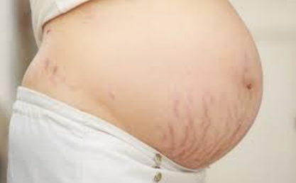 Why Stretch Marks Appear & How AreoVeda Helps Reduce Their Appearance
