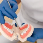Full Arch Dental Implants: Everything You Need to Know Before Making a Decision